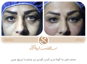نمونه تزریق چربی مشهد