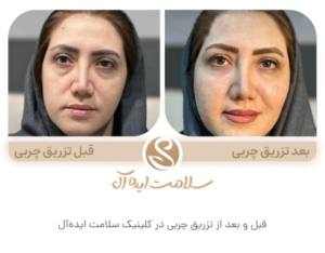 نمونه تزریق چربی مشهد