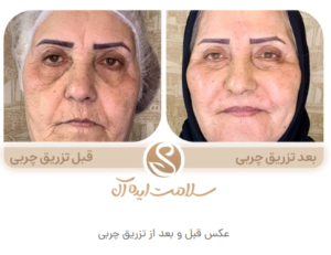 نمونه تزریق چربی مشهد