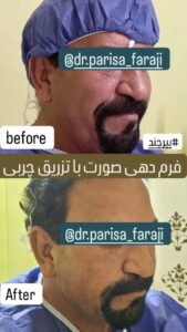 نمونه تزریق چربی (دکتر پریسا فرجی)