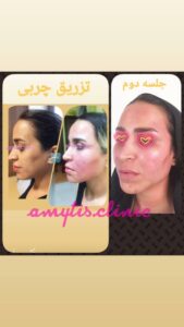 نمونه تزریق چربی (دکتر فریبا صابری)