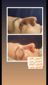 نمونه تزریق چربی (دکتر نازنین ابدالی)