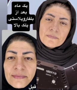 نمونه جراحی پلک دکتر نسرین تحویلدار نژاد در مشهد