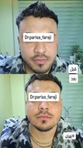 نمونه تزریق چربی (دکتر پریسا فرجی)