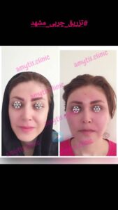 نمونه تزریق چربی (دکتر فریبا صابری)