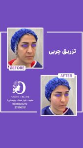 نمونه تزریق چربی (دکتر نعیمه ارگنجی)