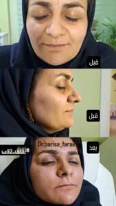نمونه تزریق چربی (دکتر پریسا فرجی)