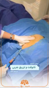نمونه تزریق چربی (کلینیک سی گل)