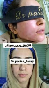 نمونه تزریق چربی (دکتر پریسا فرجی)