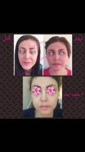 نمونه تزریق چربی (دکتر فریبا صابری)