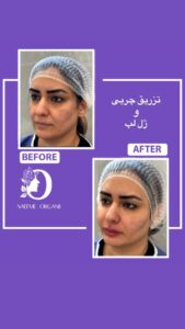 نمونه تزریق چربی (دکتر نعیمه ارگنجی)