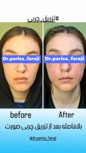 نمونه تزریق چربی (دکتر پریسا فرجی)