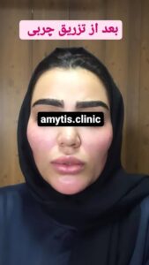 نمونه تزریق چربی (دکتر فریبا صابری)