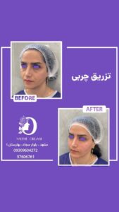 نمونه تزریق چربی (دکتر نعیمه ارگنجی)