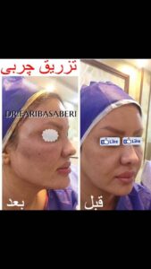 نمونه تزریق چربی (دکتر فریبا صابری)