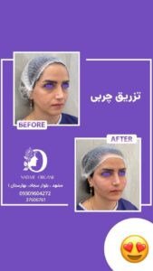 نمونه تزریق چربی (دکتر نعیمه ارگنجی)
