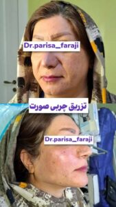نمونه تزریق چربی (دکتر پریسا فرجی)