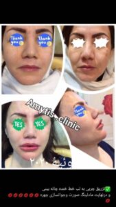 نمونه تزریق چربی (دکتر فریبا صابری)