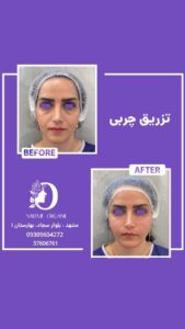 نمونه تزریق چربی (دکتر نعیمه ارگنجی)