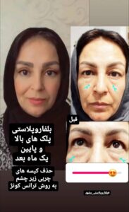 نمونه جراحی پلک دکتر نسرین تحویلدار نژاد در مشهد