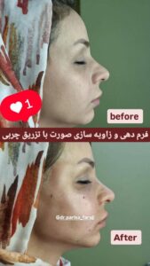 نمونه تزریق چربی (دکتر پریسا فرجی)