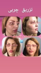 نمونه تزریق چربی (دکتر فریبا صابری)