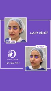 نمونه تزریق چربی (دکتر نعیمه ارگنجی)