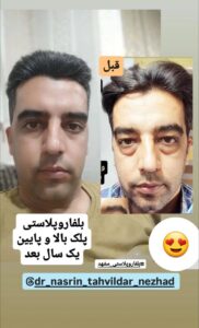 نمونه جراحی پلک دکتر نسرین تحویلدار نژاد در مشهد