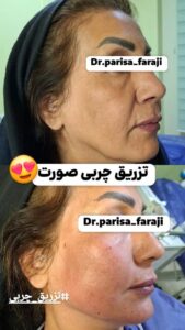 نمونه تزریق چربی (دکتر پریسا فرجی)