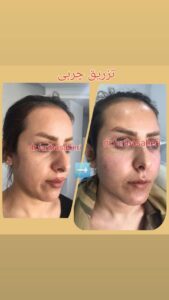 نمونه تزریق چربی (دکتر فریبا صابری)