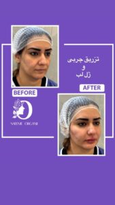 نمونه تزریق چربی (دکتر نعیمه ارگنجی)
