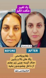 نمونه جراحی پلک دکتر نسرین تحویلدار نژاد در مشهد