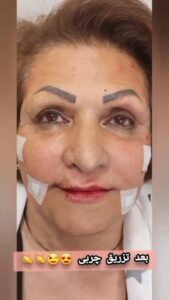 نمونه تزریق چربی (کلینیک دنیز)