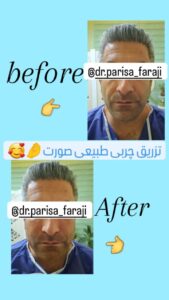 نمونه تزریق چربی (دکتر پریسا فرجی)