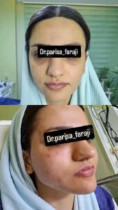 نمونه تزریق چربی (دکتر پریسا فرجی)