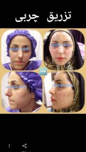نمونه تزریق چربی (دکتر فریبا صابری)