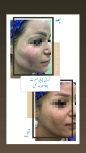 نمونه تزریق چربی (دکتر نعیمه ارگنجی)