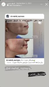نمونه کار تزریق چربی دکتر مهدی رزم آرا در مشهد