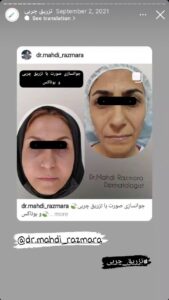 نمونه کار تزریق چربی دکتر مهدی رزم آرا در مشهد