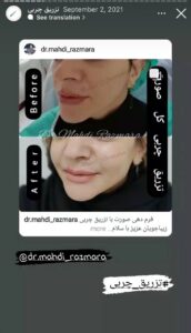 نمونه کار تزریق چربی دکتر مهدی رزم آرا در مشهد