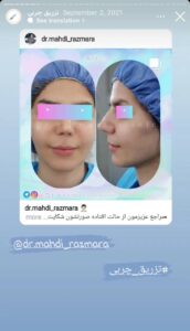 نمونه کار تزریق چربی دکتر مهدی رزم آرا در مشهد