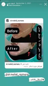 نمونه کار تزریق چربی دکتر مهدی رزم آرا در مشهد