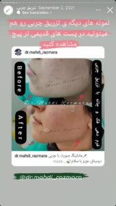 نمونه کار تزریق چربی دکتر مهدی رزم آرا در مشهد