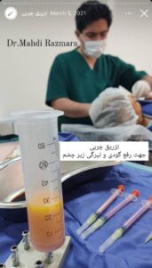 نمونه کار تزریق چربی دکتر مهدی رزم آرا در مشهد