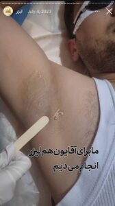 نمونه کار لیزر موهای زائد (کلینیک پرنیان)