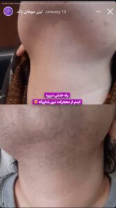 نمونه کار لیزر مو های زائد کلینیک شاپرک در مشهد