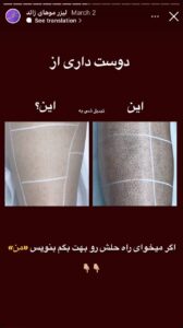 نمونه کار لیزر مو های زائد کلینیک شاپرک در مشهد
