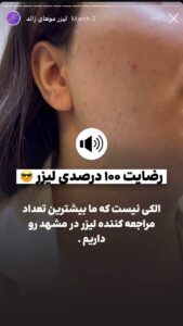 نمونه کار لیزر مو های زائد کلینیک شاپرک در مشهد
