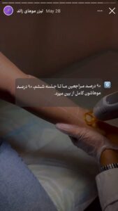 نمونه کار لیزر مو های زائد کلینیک شاپرک در مشهد