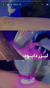 لیزر موهای زائد کلینیک مریم در مشهد